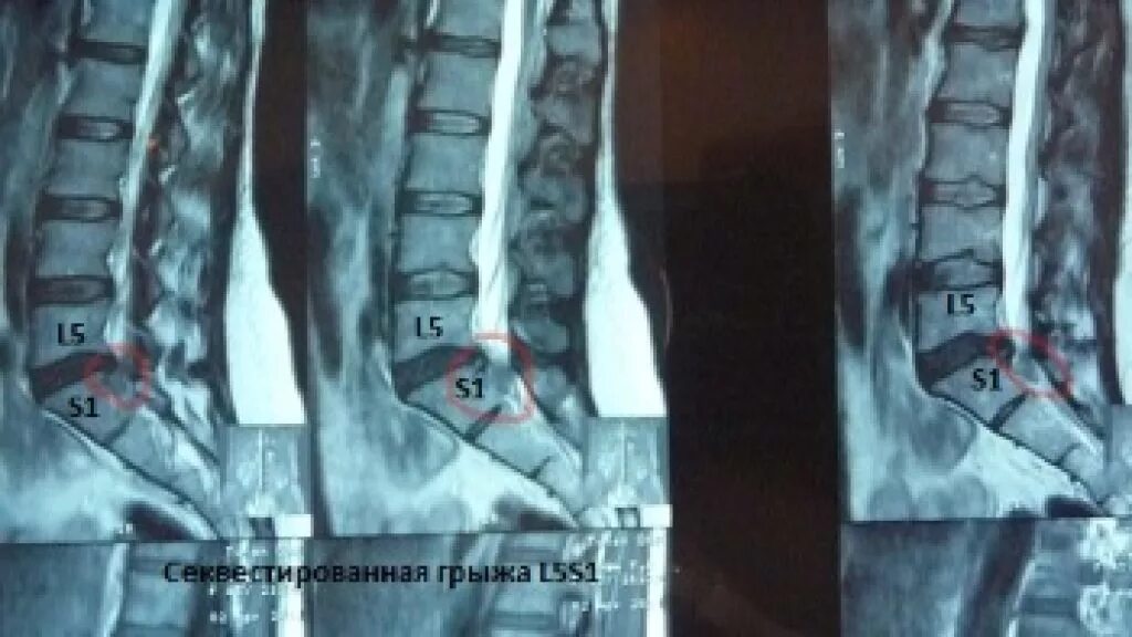 Грыжа поясничного отдела l5-s1 операция. Межпозвоночная грыжа крестцового отдела операция. Операция на межпозвоночную грыжу поясничного отдела. Операция грыжи крестцового отдела позвоночника. Операция на позвоночнике болит нога