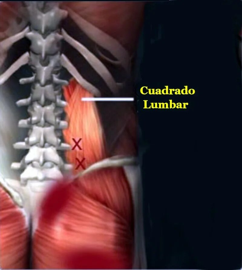 спазм квадратной мышцы