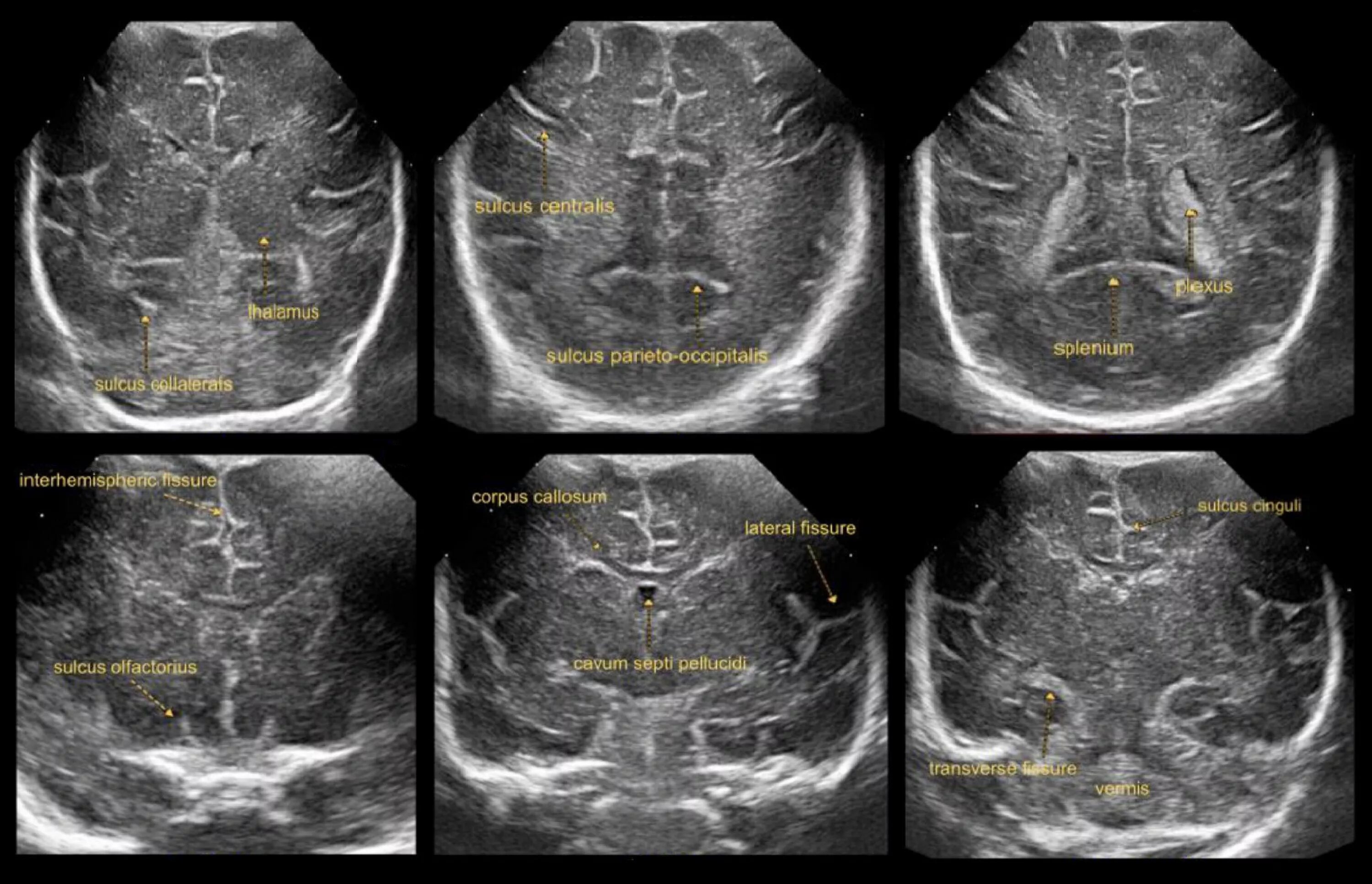 Нсг мозга. Ультразвуковое исследование головного мозга - нейросонография (НСГ). УЗИ анатомия НСГ. УЗИ головного мозга у новорожденных НСГ. Нейросонография срезы головного мозга.