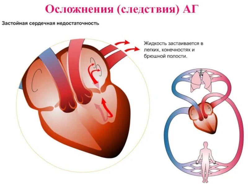 Застойная сердечная недостаточность. Осложнения артериальной гипертонии. Осложнения гипертонической болезни. Гипертония в слайдах.