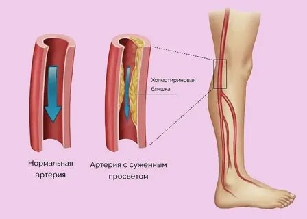 Ишемическая конечность
