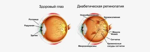 Ретинопатия глаза симптомы