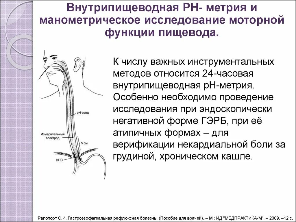 Суточная PH метрия ГЭРБ. 24 Часовая РН метрия. PH-метрия пищевода зонд. Внутрипищеводная PH-метрия. Анализ пищевода