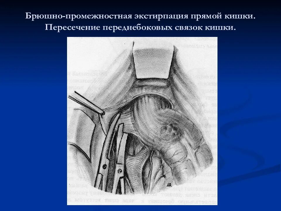 Брюшно промежностная экстирпация прямой. Брюшно промежностная экстирпация прямой. Брюшноанальную экстирпацию прямой кишки. Брюшно-промежностная экстирпация прямой кишки. Брюшностно промпжнстная экстирпация прямой кишки.