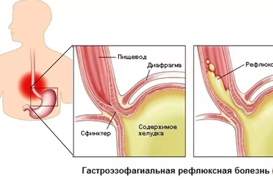 Рефлюкс у подростков. Дуодено-гастральный рефлюкс. гастральный рефлюкс симптомы. дуоденогастральный рефлюкс это. дуоденальный рефлюкс это.