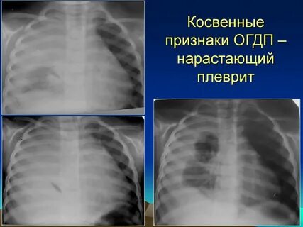 Плеврит у детей