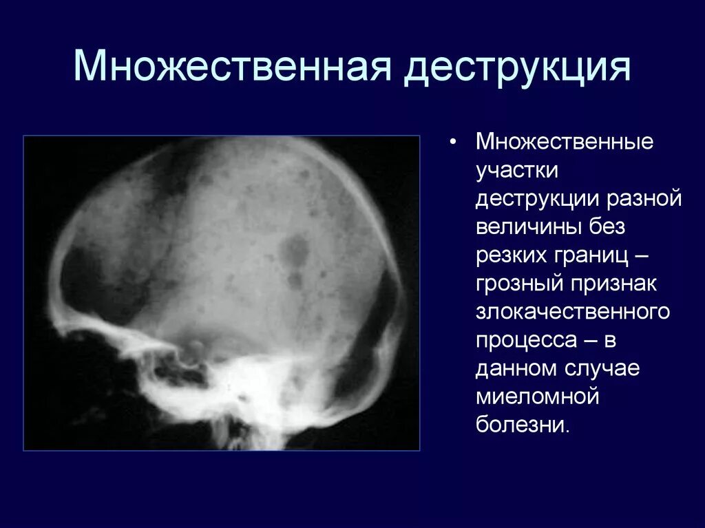 Множественные округлые. Миеломная болезнь рентген черепа. Миеломная болезнь рентген костей. Миеломная болезнь череп. Миеломная болезнь на кт черепа.