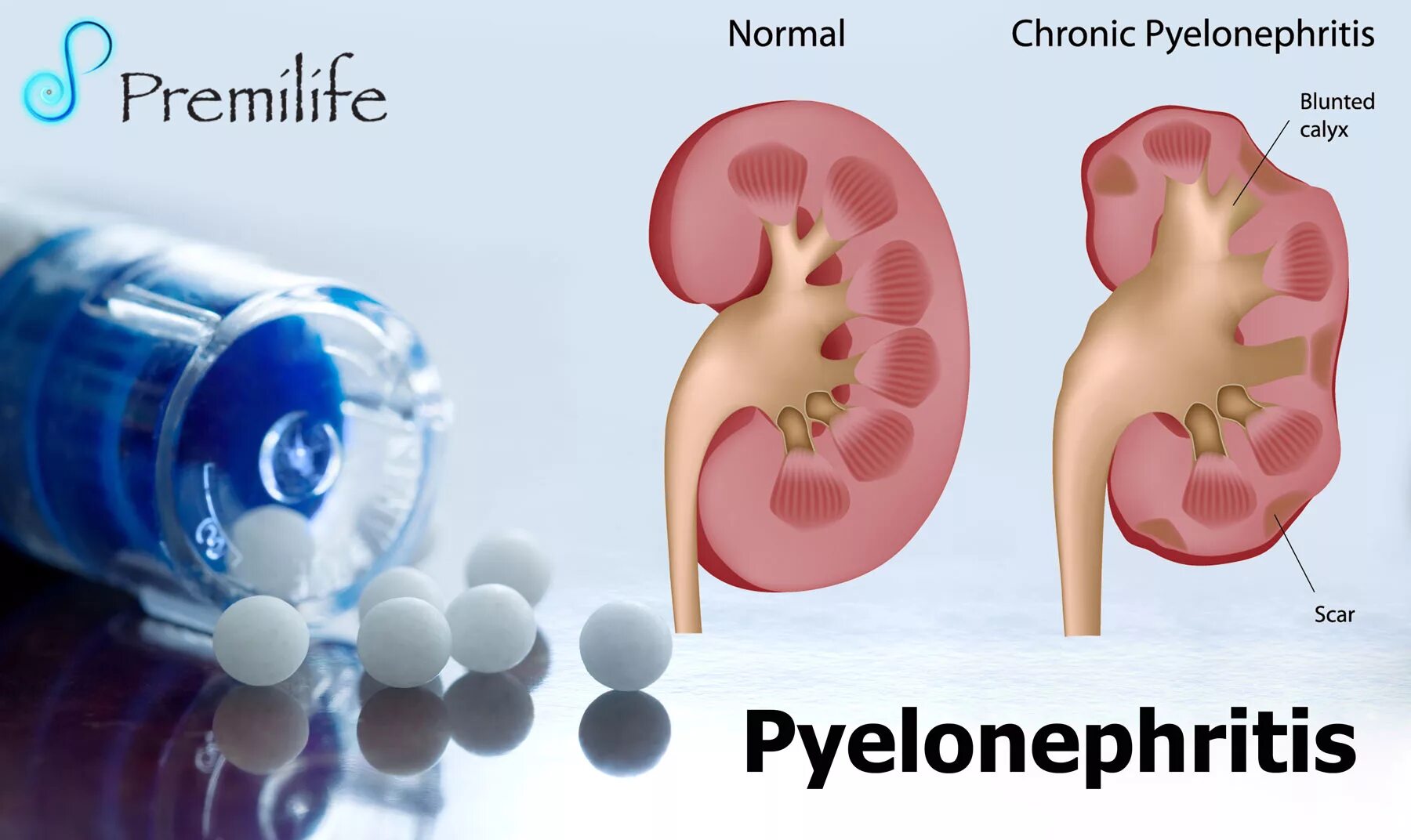 Хронический пиелонефрит. Острый и хронический пиелонефрит. Пиелонефрит описание