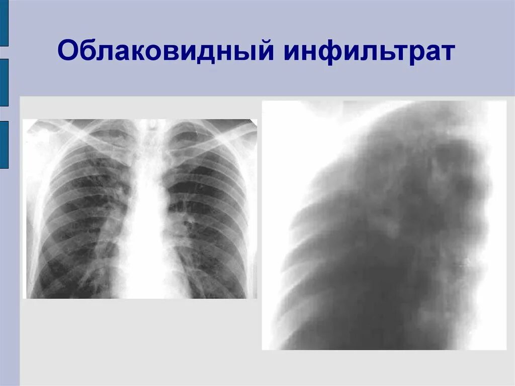 Округлый инфильтрат. Инфильтративный туберкулез рентген. Облаковидный инфильтративный туберкулез. Лобулярный инфильтративный туберкулез рентген. Инфильтративный туберкулез облаковидный инфильтрат.