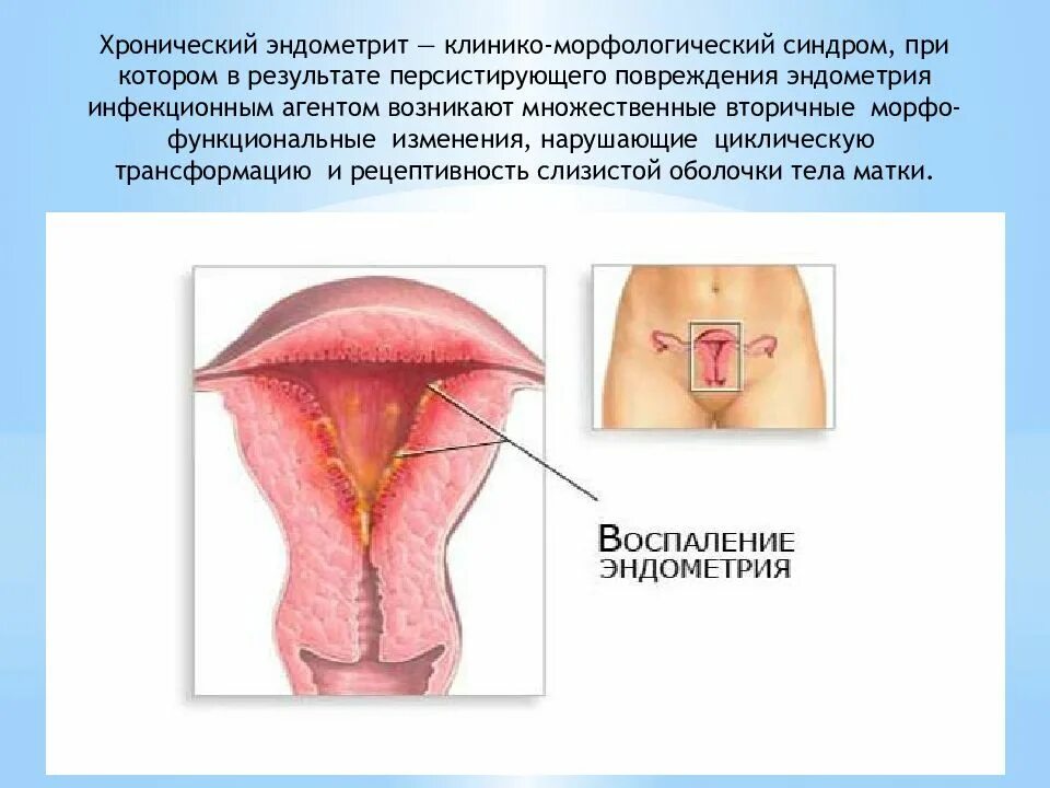 Воспаление матки у женщин симптомы и лечение. Послеродовой эндометрит. Инфекционный эндометрит. Эндометрит гинекология. Септический эндометрит.