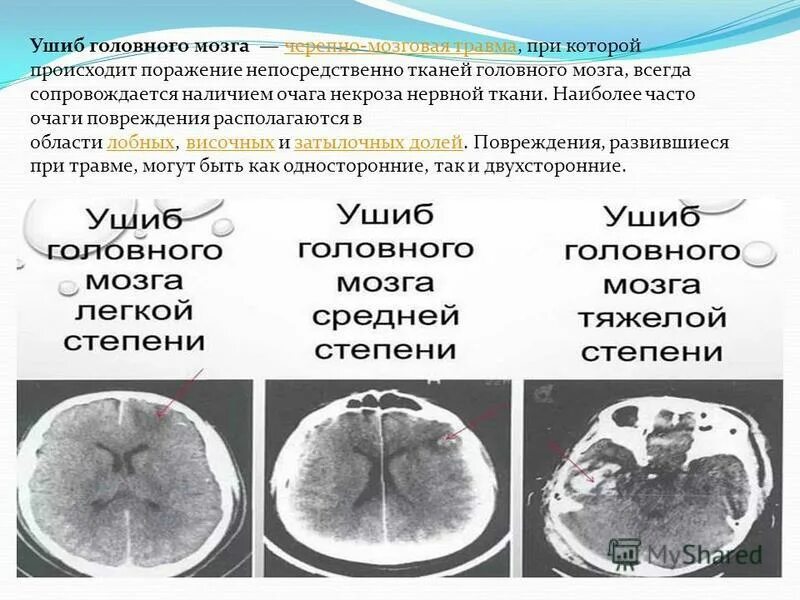 Травма головы код