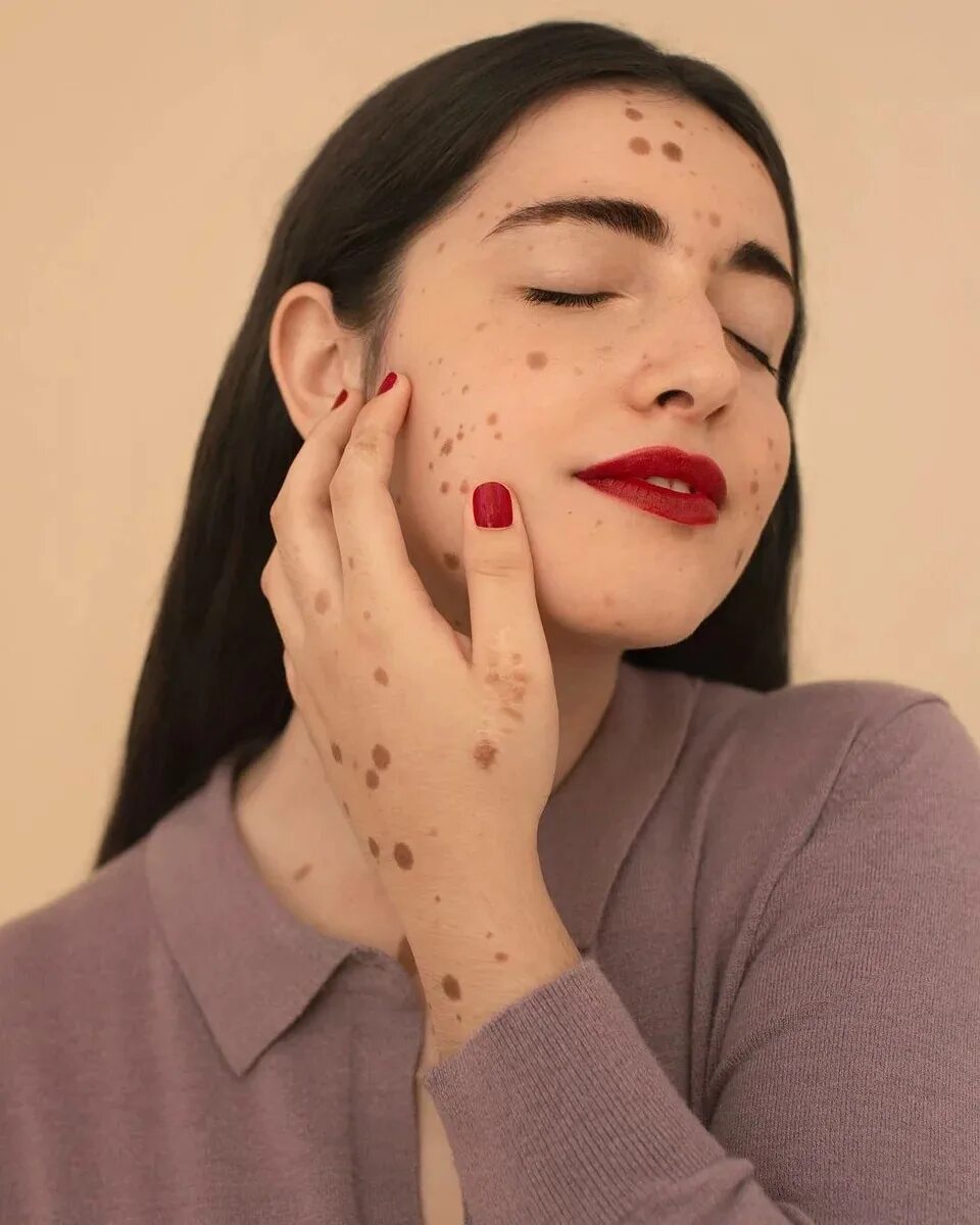 Люди с большими родинками. Большие родимые. Красивая девушка с родинками на теле. Cassandra naud. Большие родимые.