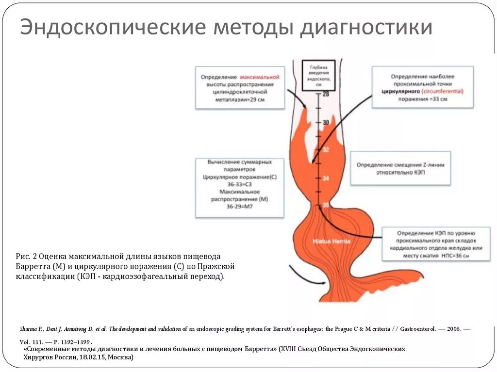 Пищевод баретта