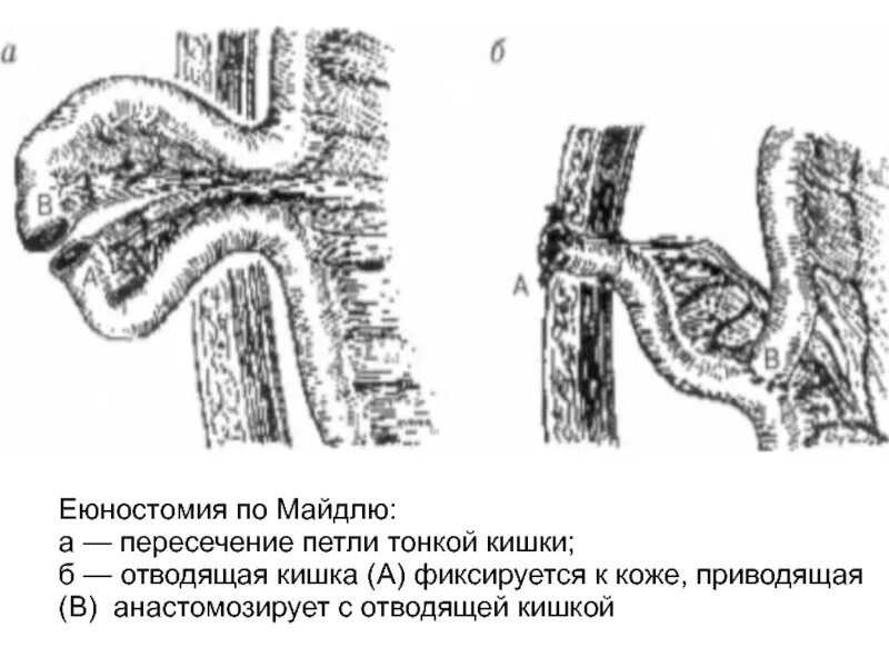Еюностома это. Еюностомия по майдлю техника. еюностома техника операции.