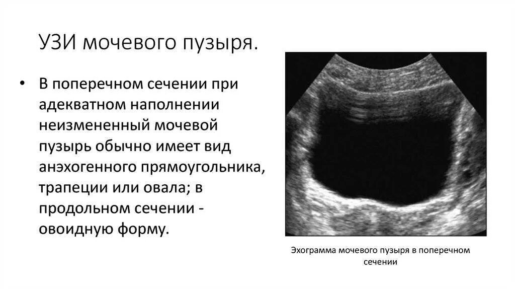 Узи брюшной полости полный мочевой пузырь. УЗИ мочевого пузыря при цистите. УЗИ мочевыделительной системы в норме. УЗИ мочевого пузыря показатели в норме. УЗИ мочевого пузыря норма у женщин.