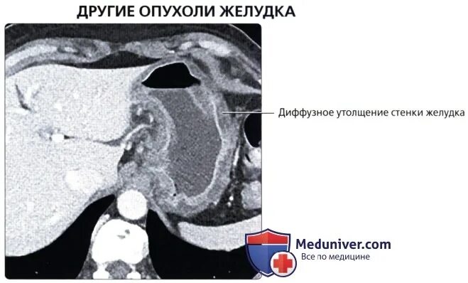 Язва желудка кт. Утолщение стенок желудка на кт. образование желудка на кт.