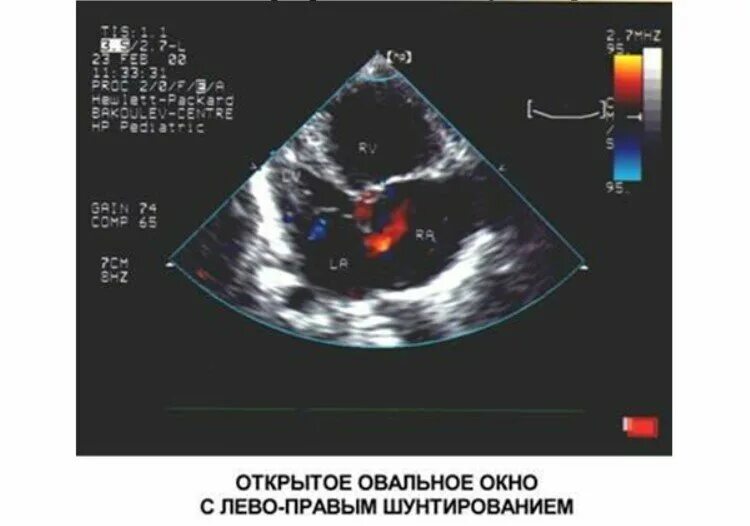 Окно в сердце у ребенка. Открытое овальное окно эхокардиография. Открытое овальное окно на ЭХОКГ. Открытое овальное окно у новорожденных на УЗИ. Открытое овальное окно в МПП.