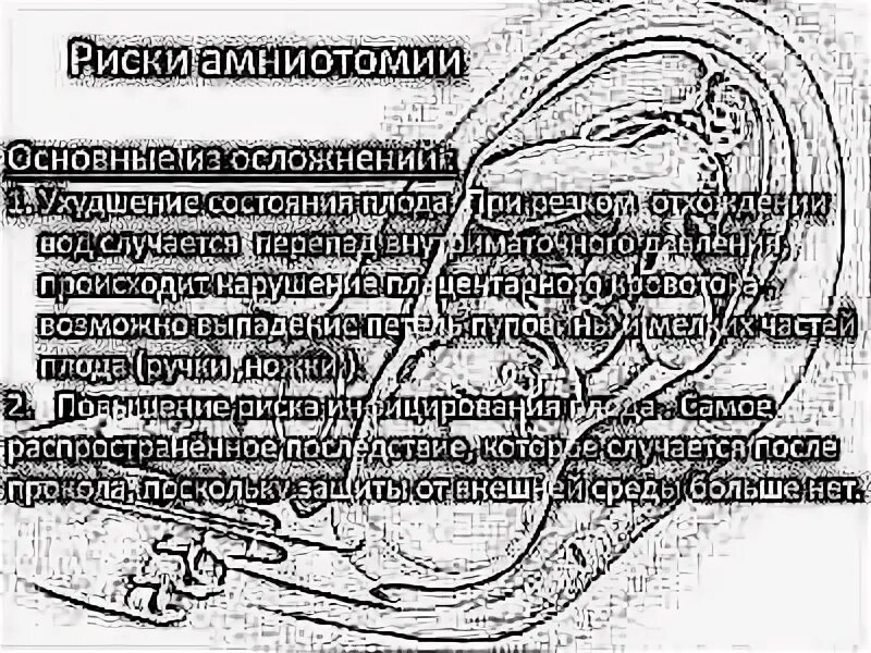 Прокол пузыря перед родами. Процедура прокалывания пузыря в родах. Прокалывание пузыря при беременности на 39 неделе. Как прокалывают пузырь у беременных. Сколько роды после прокола пузыря