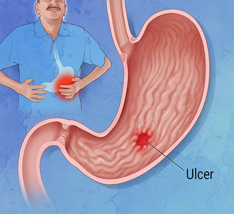 Язвенные заболевания желудка. Язва желудка и двенадцатиперстной кишки. Язва желудка лечение у мужчин