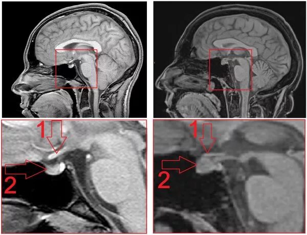 Гипофиз у мужчин. Супраселлярная аденома гипофиза мрт. Микроаденома гипофиза головного мозга на кт. Аденома гипофиза снимок мрт. Аденома гипофиза патология.