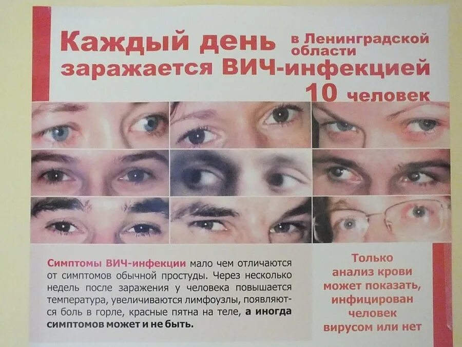 Глаза у ВИЧ инфицированных. Глазные проявления ВИЧ. У вич инфицированных и заболевших спидом людей