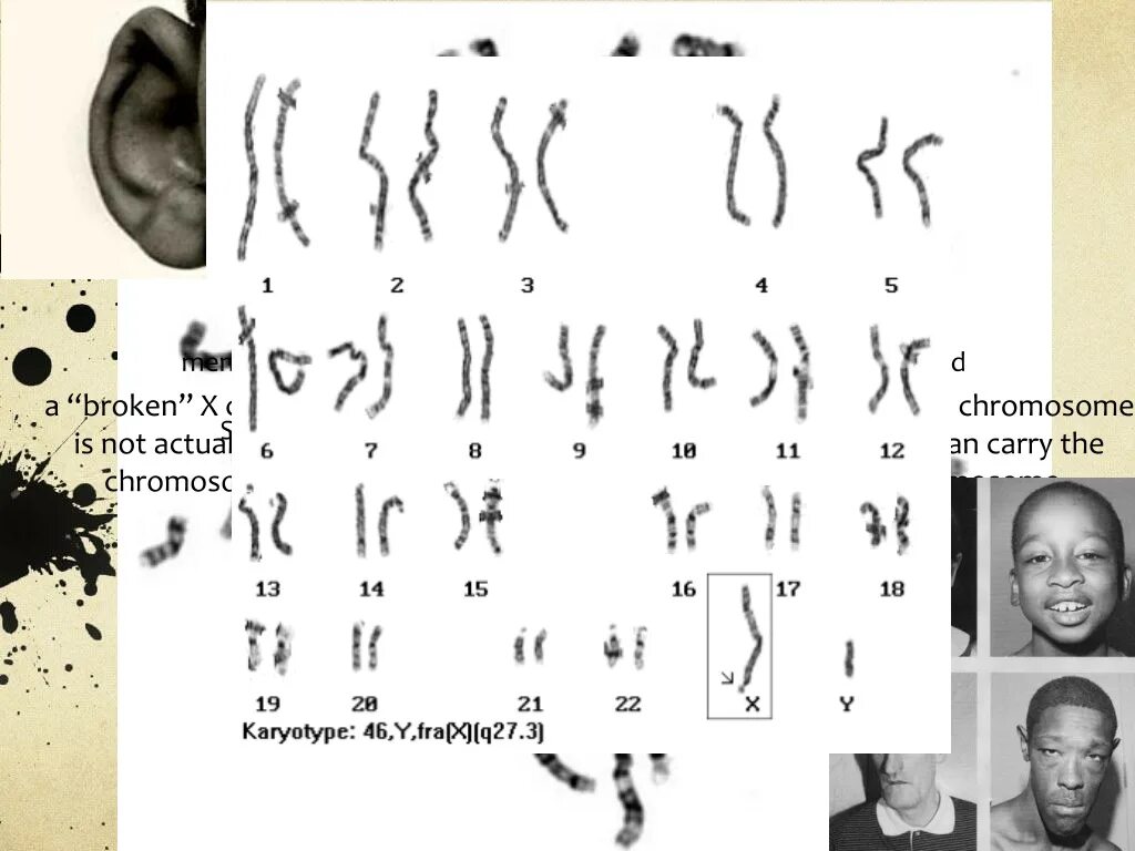 Отсутствие х хромосомы у мужчин. Синдром ломкой х-хромосомы кариотип.