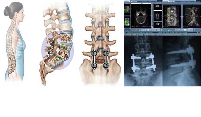 Транспедикулярная фиксация позвоночника l4-l5. L5/s1 вытяжение позвоночника. Задний спондилодез l5 l6. Передний спондилодез l5. Конструкция позвоночника операция
