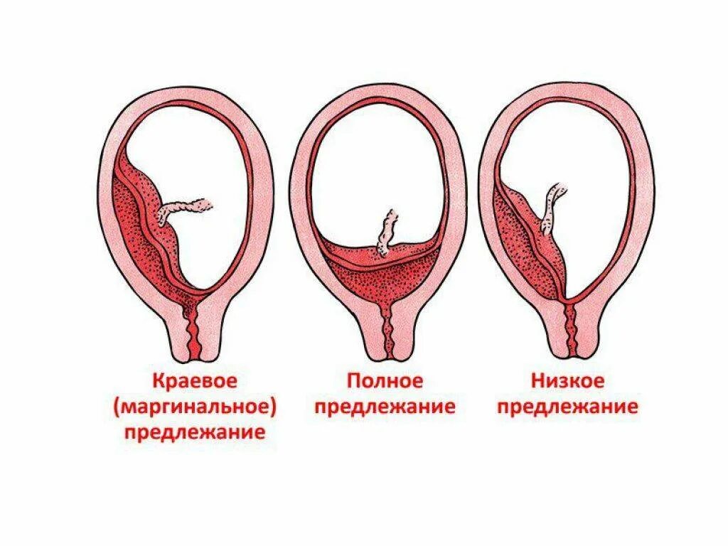 Зев шейки матки закрыт. Типы прикрепления плаценты. Плацента краевое предлежание плаценты. Предлежание плаценты хориона. Полное и неполное предлежание плаценты.