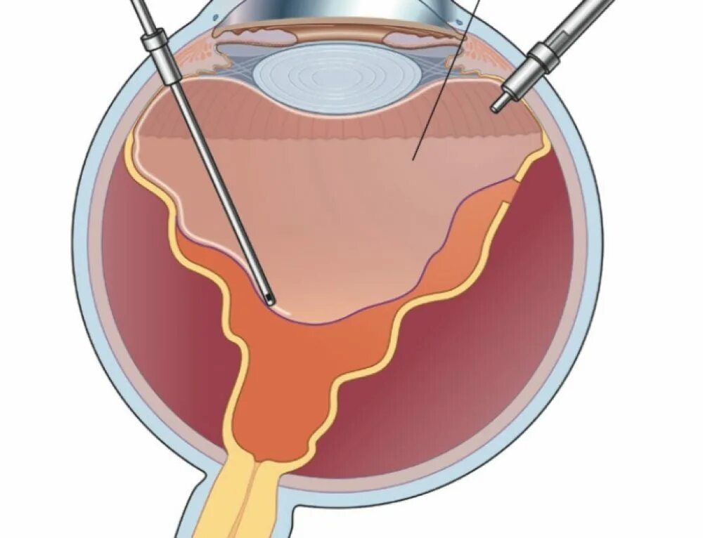 Витреоретинальная тампонада. Операция витрэктомия глаза. Витрэктомия сетчатки глаза. Трехпортовая витрэктомия. Стекловидное тело операция