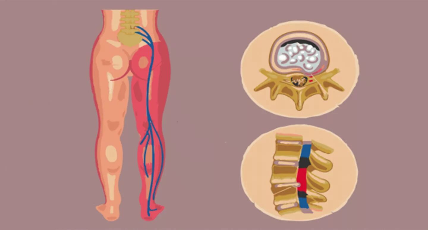 Люмбоишиалгия поясничного отдела позвоночника. Радикулопатия седалищного нерва. Вертеброгенная люмбоишиалгия. Грыжа позвоночника и ишиалгия. Как вылечить защемление седалищного нерва