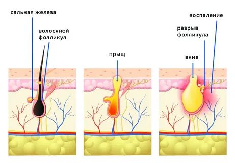 Фолликулит причины лечение