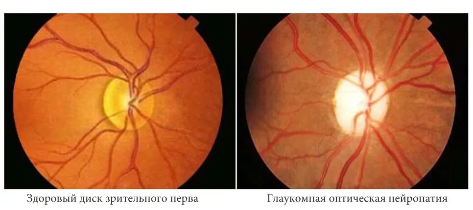 Тип зрительного нерва. Наследственная нейропатия зрительного нерва Лебера. Колобома зрительного нерва. Наследственная атрофия зрительных нервов Лебера.