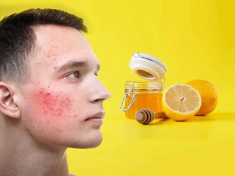 Как избавиться от прыщей на лице быстро. Какизбавится от прыщей на лице. прыщи на лице избавление. как избавиться от бришей.