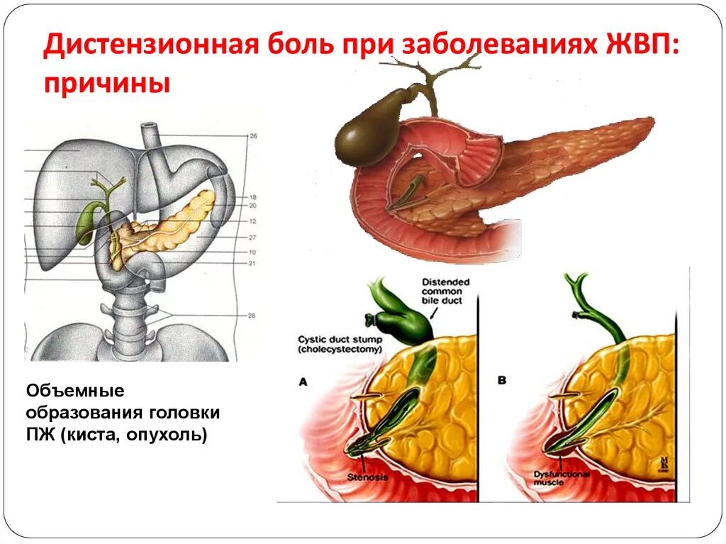Заболевания желчных путей. Дискинезия желчевыводящих путей печени. дискинезия жвп этиология. дискинезия желчного пузыря.