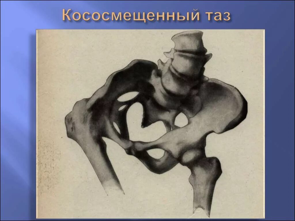 Современный таз. Кососмещенный и кососуженный таз. кососуженный таз акушерство. воронкообразный таз в акушерстве. редкие формы сужения таза.