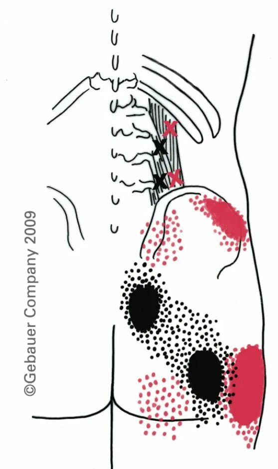 Точки на пояснице. Квадратная поясничная мышца триггерные точки. Квадратная мышца спины триггерные точки. Боль в спине триггерные точки. Массаж триггерных точек ягодиц.