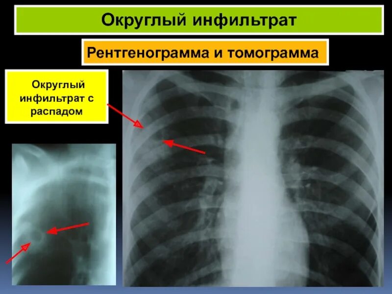 Округлый инфильтрат