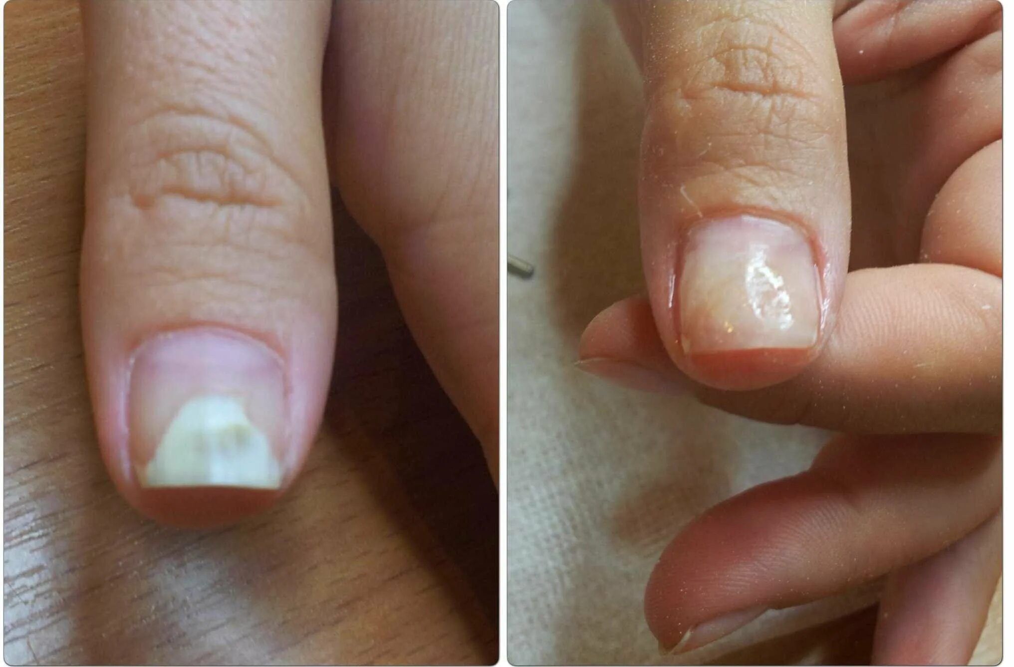 Что делать после снятия ногтя. Ониходистрофия - онихолизис.. Онихолизис ногтевой пластины.