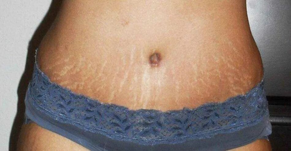 Избавление от растяжек. Как избавиться от растяжек после родов. Растяжки на животе от полноты. Контрактубекс растяжки после родов. Как избавиться от растяжек после родов.