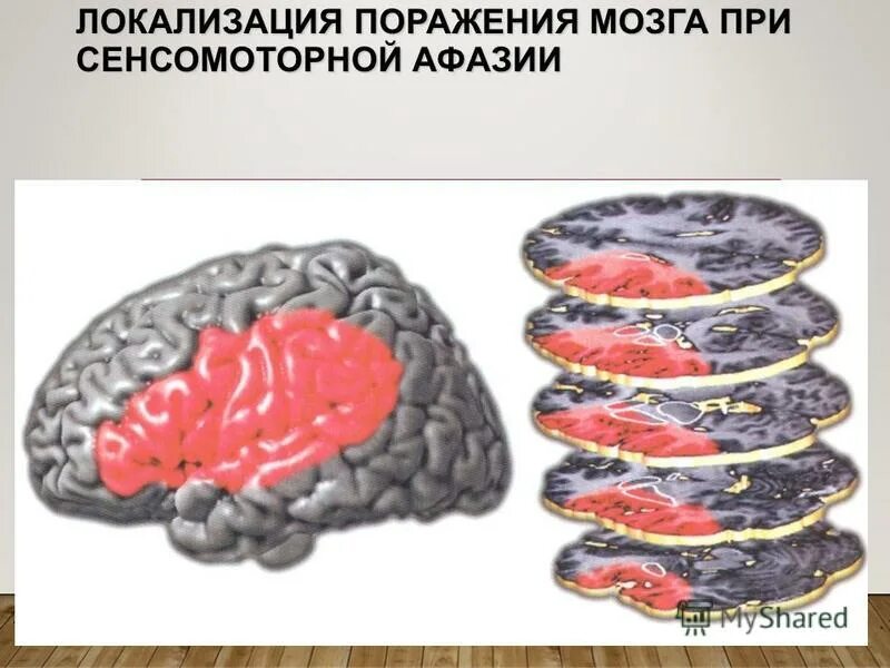 сенсомоторная афазия после инсульта