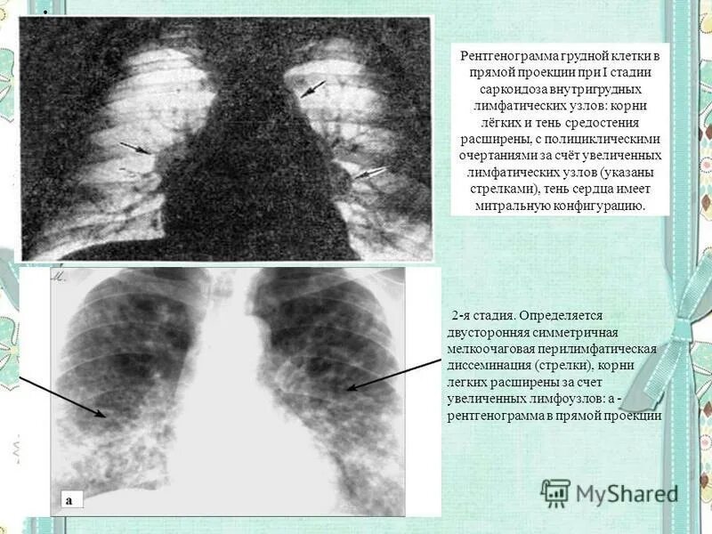 Саркоидоз лёгких рентгенописание. Саркоидоз лёгких формы рентген. Саркоидоз диссеминация. Саркоидоз рентгенологическая картина. Увеличение лимфоузлов в легких причины