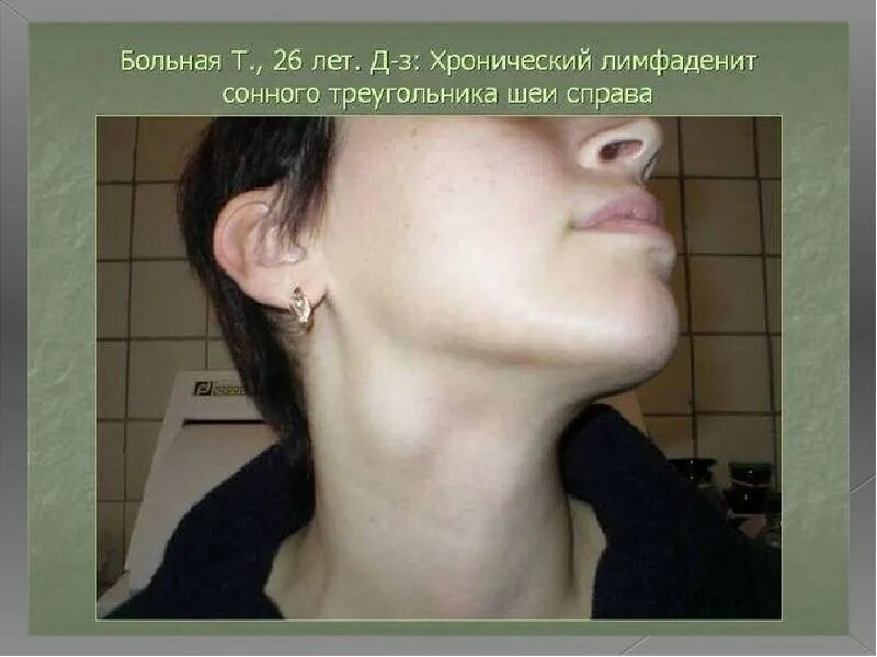 Лимфоузел верхней челюсти