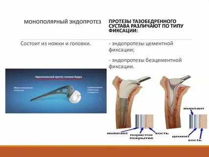 Бесцементное эндопротезирование тазобедренного сустава