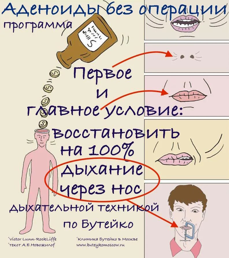 Как лечить аденоиды у детей без операции. Схема лечения аденоидов у детей. аденоиды у детей 1 степени. схема лечения аденоидита у ребенка.