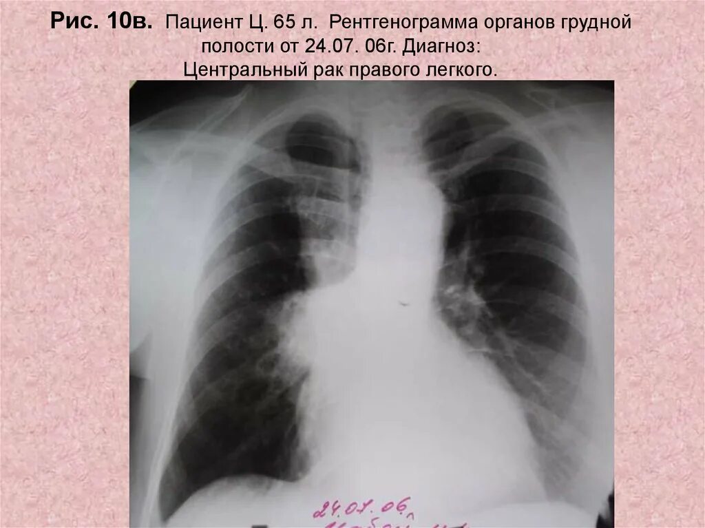 Уентральныйрак легкого. Рентгенограмма опухоль легкого. Опухоль легкого на рентгене. Центральный рак правого