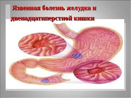 Больной язвенной болезнью