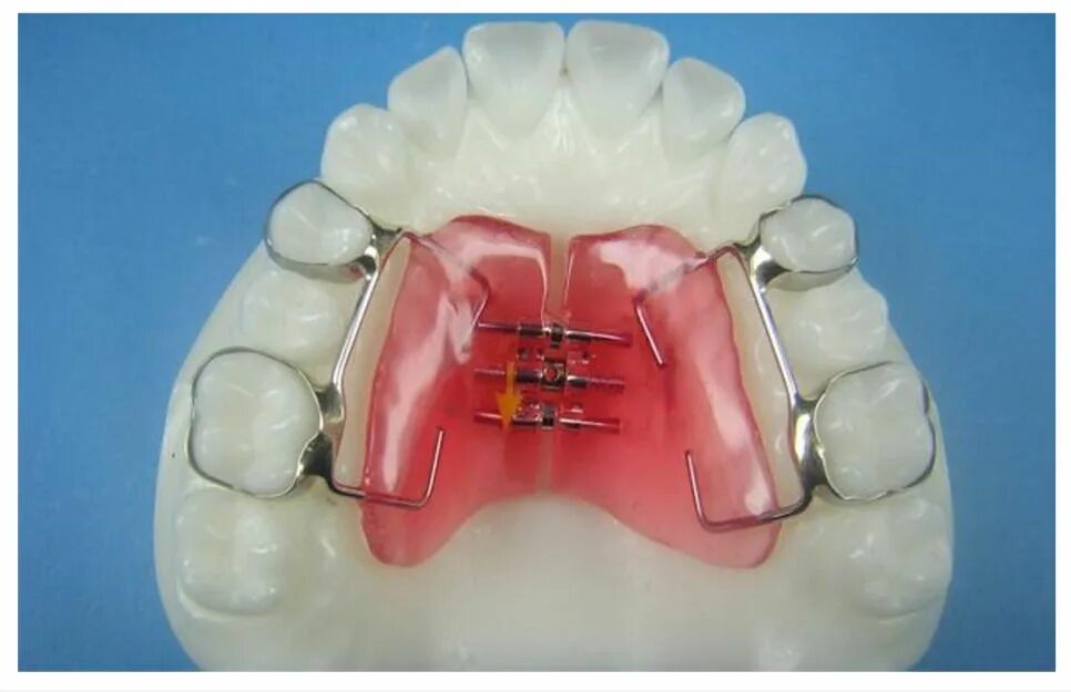 Ортодонтический аппарат Хаас. Пластина Марко Росса ортодонтия. Аппарат Haas для расширения верхней челюсти. Ортодонтический аппарат Марко Росса.