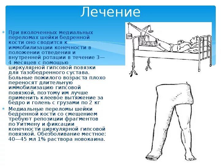 Перелом шейки бедренной кости иммобилизация. План реабилитации при переломе шейки бедра. Перелом шейки бедра наложение гипса. Гипсовая повязка перелом шейка бедра. Срок лечения шейки бедра