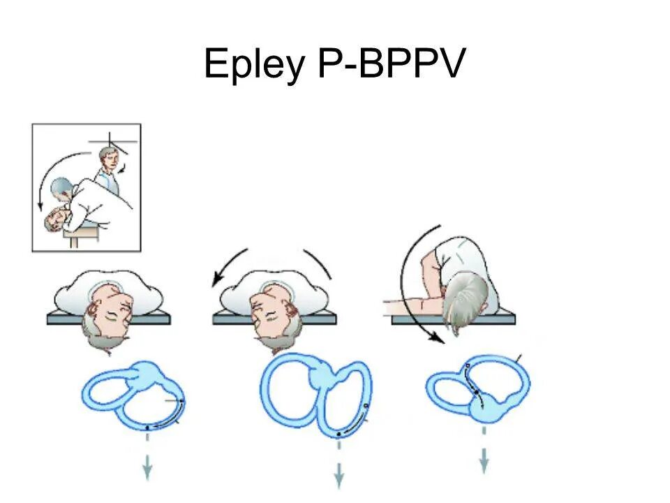 Маневры Эпли при головокружении. Головокружение маневр Эпли. ДППГ доброкачественное пароксизмальное позиционное головокружение. Упражнение Эпли при головокружении.