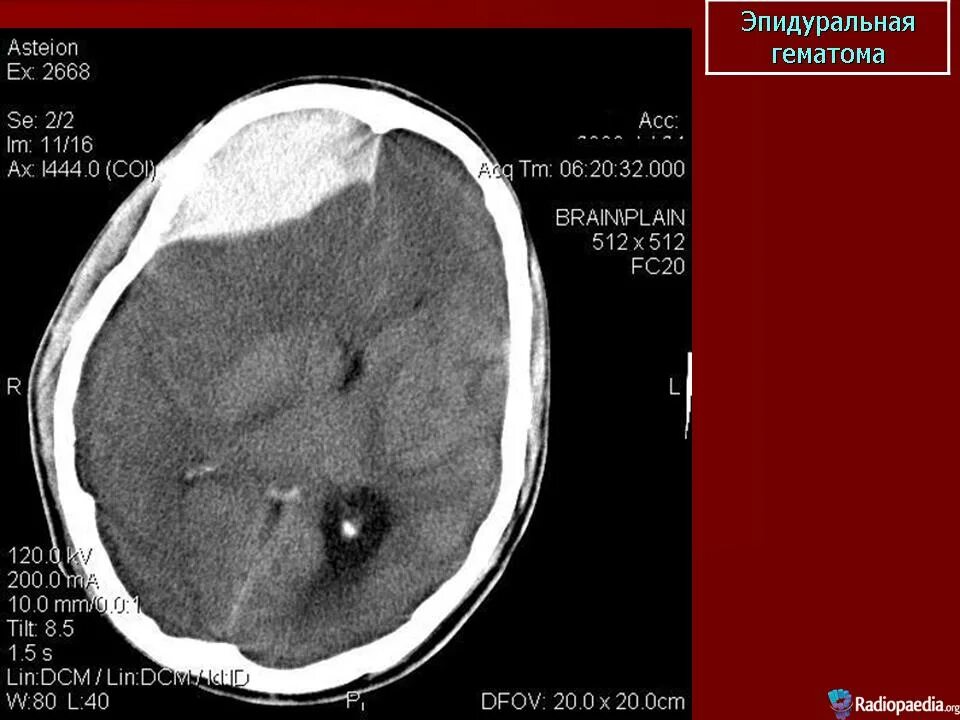 Подапоневротическая гематома мрт. Подапоневротическая гематома кт. Эпидуральная гематома операция. Подапоневротическая и эпидуральная гематома. Гематома мозга операция